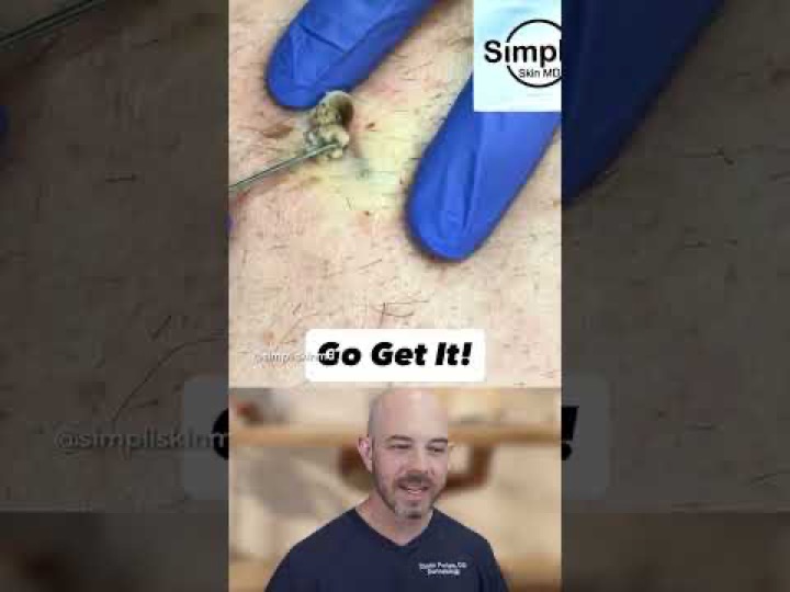 This is a crazy cyst
