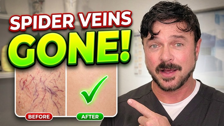 The Only PROVEN Way To Get Rid Of Spider Veins Effectively At Home
