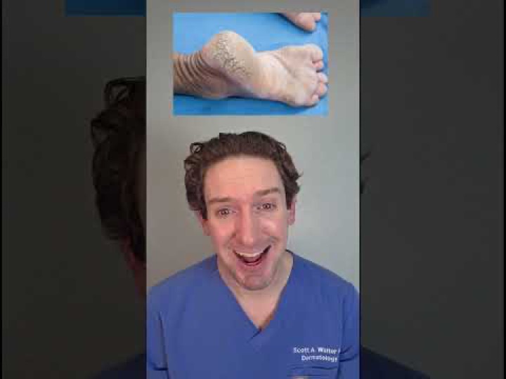 Derm hack for dry cracked heals? Use this! #crackedheels #dryheels #callus #dermhack #ureacream