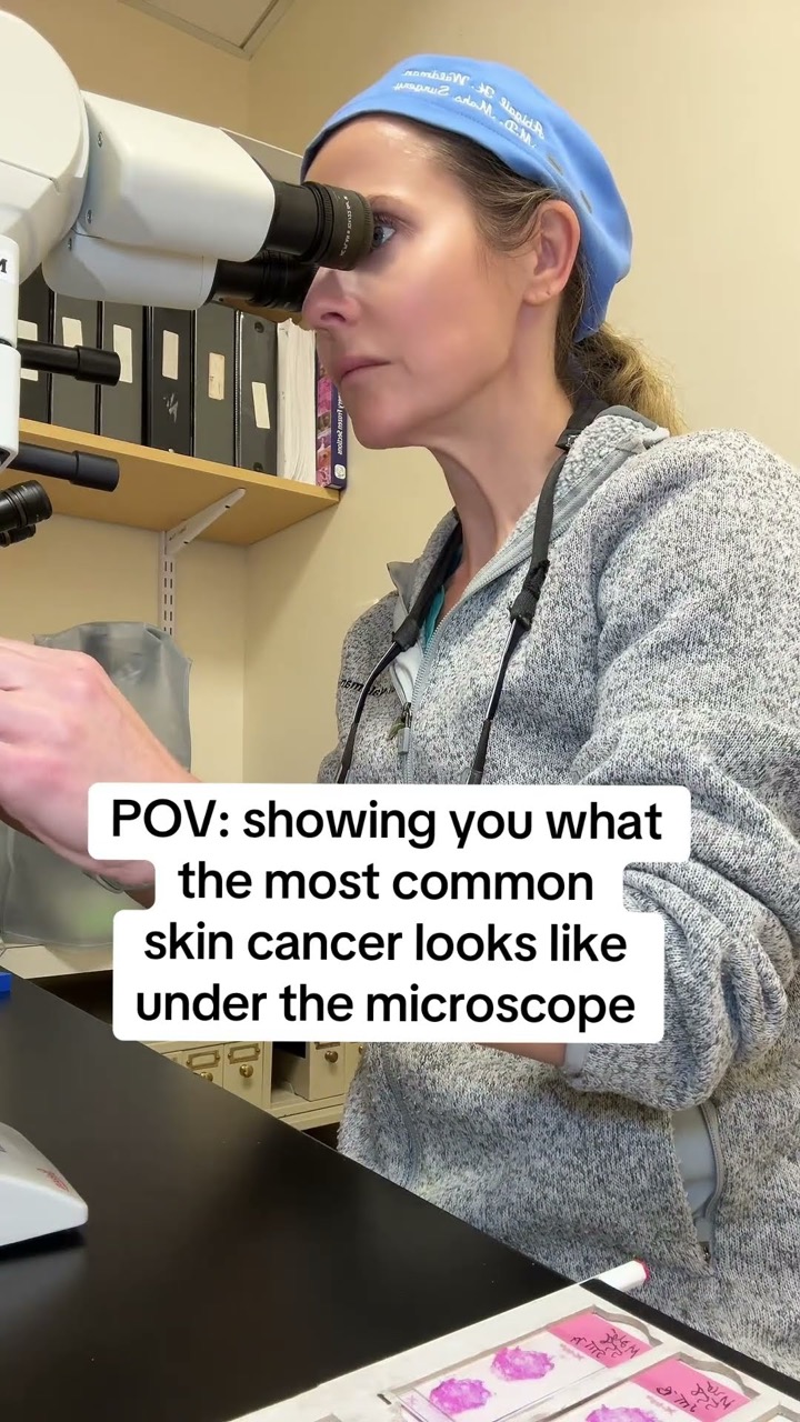 Showing you what the most common skin cancer looks like under a microscope 🔬 #skincancer #bcc