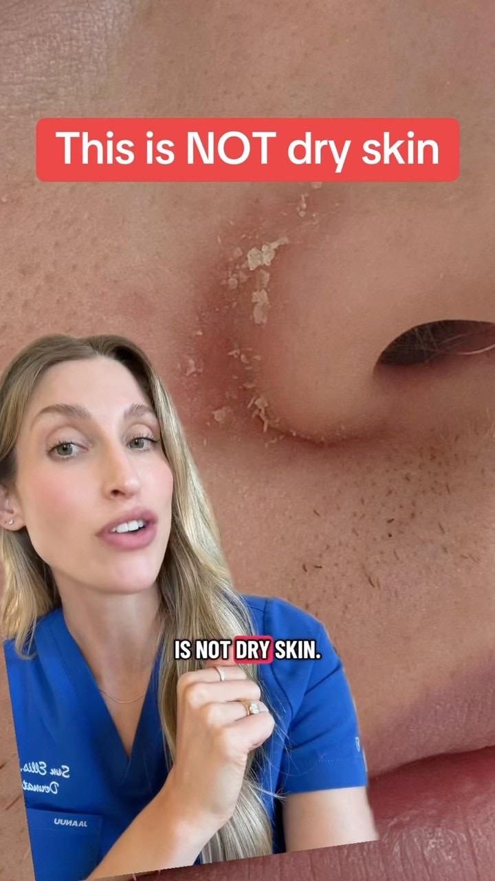 Shouting it from the rooftops! Stop trying to moisturize this. #dryskin