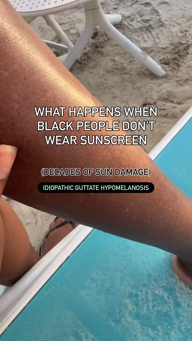 idiopathic = kinda random
guttate = spots
hypomelanosis = missing melanin

The condition is caused by cumulative UV exposure. It often take 