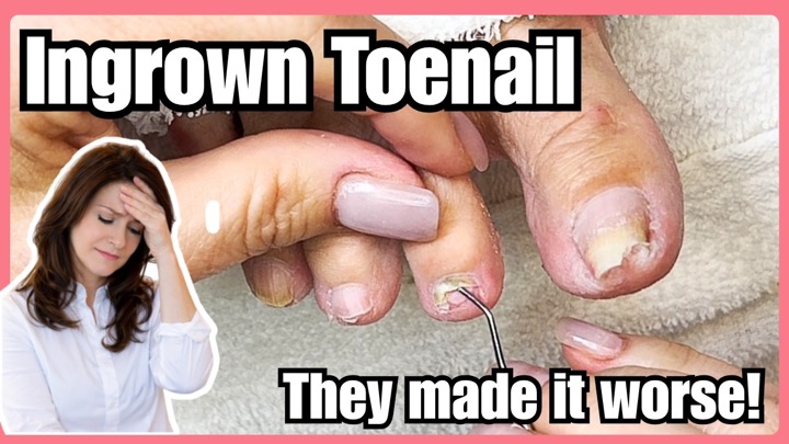 Ingrown Toenail: She Told Them Not to Touch it and They Did Anyway