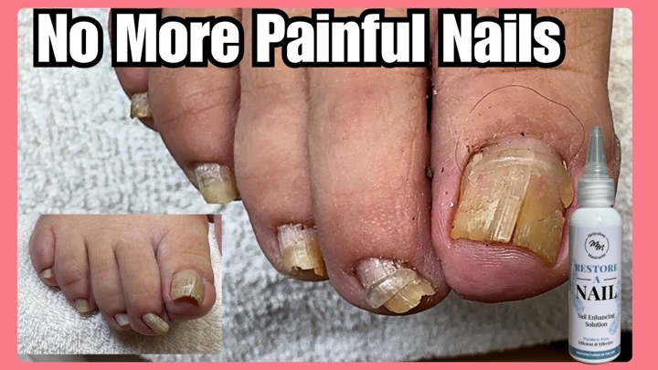 They Said This Toenail Needed Surgery... They Were Wrong