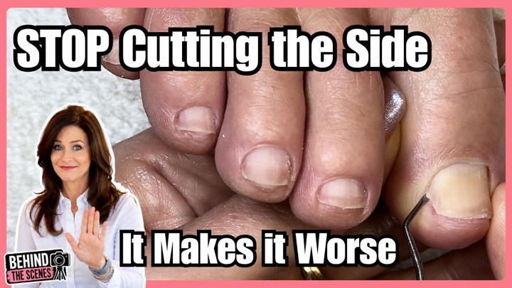 Ingrown Toenail Pain? She Thought She Needed Surgery… But This Was Hiding Inside