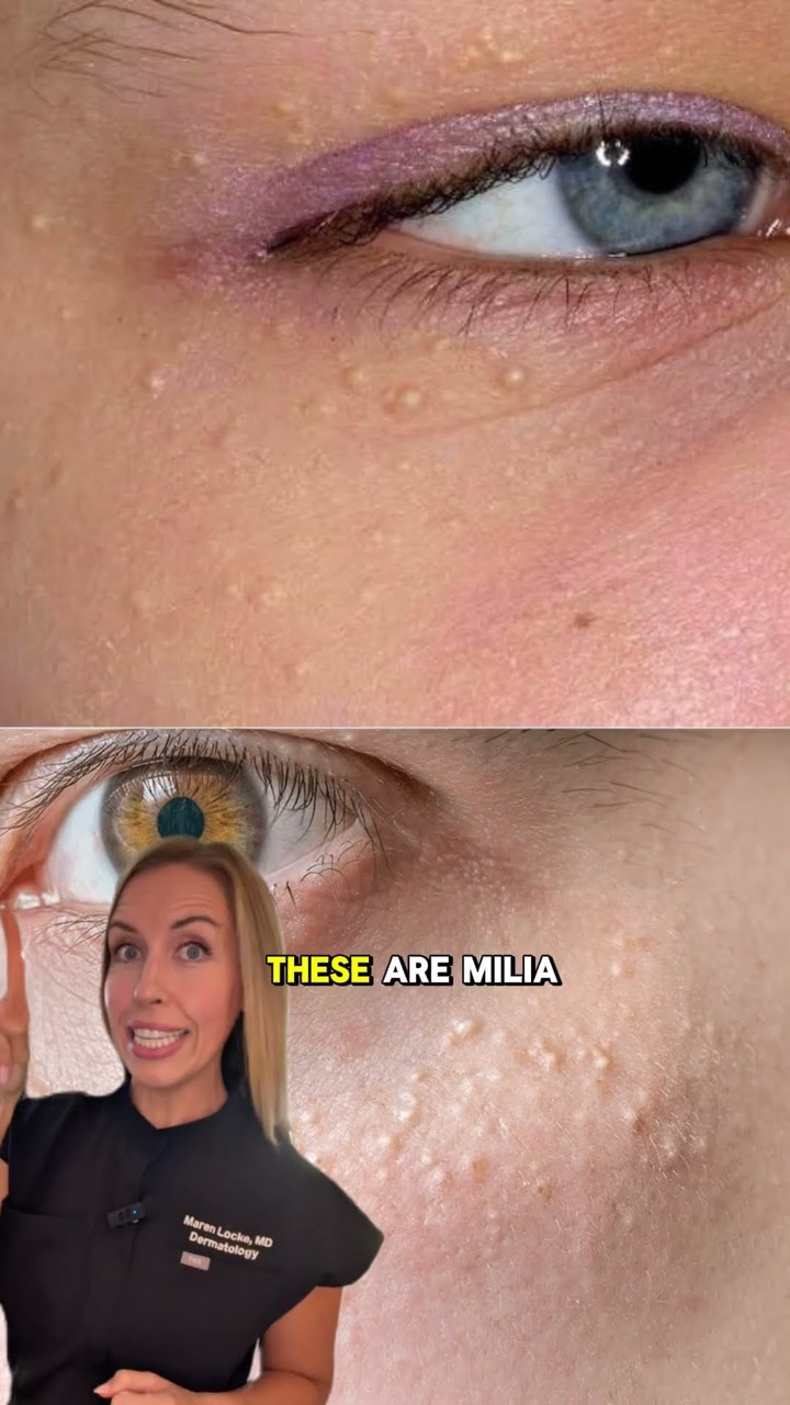 These look like acne but they are NOT ACNE!