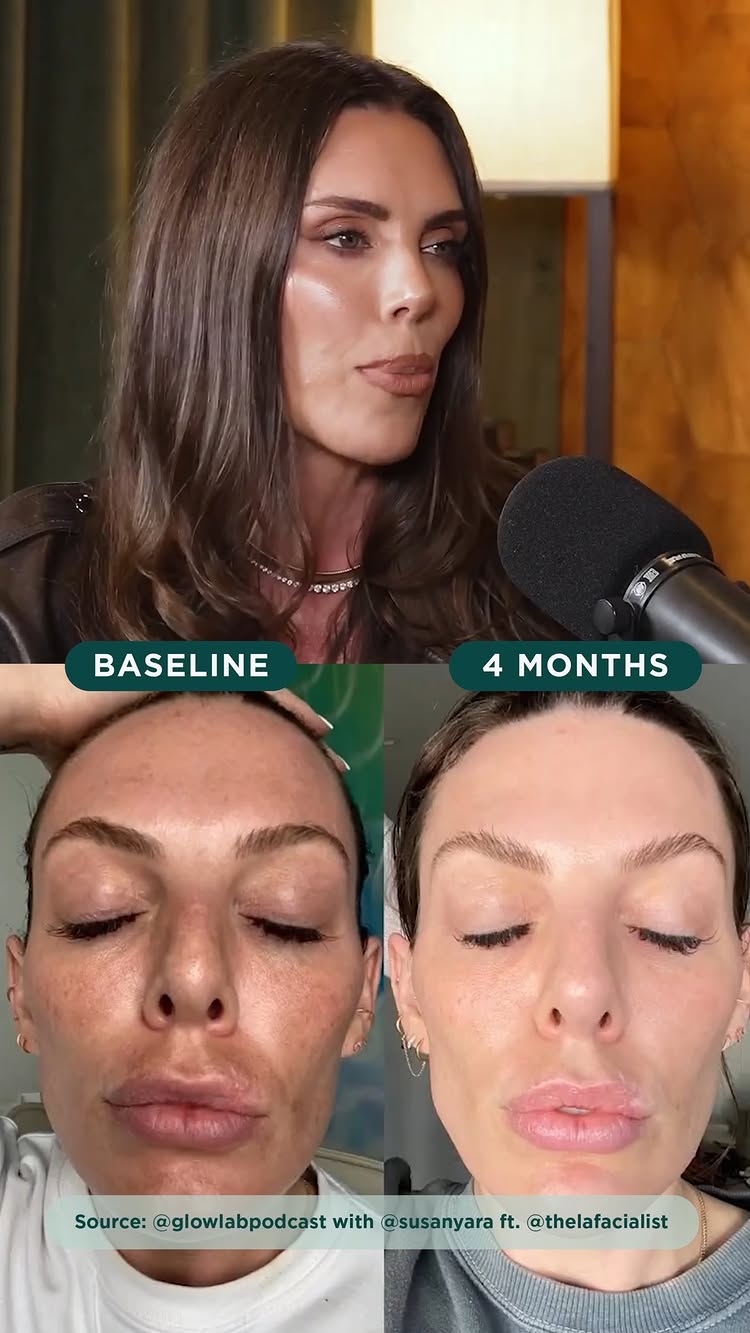Renowned medical aesthetician Candace Marino, owner of @thelafacialist, shares her experience with Marini SkinSolutions on the latest episod